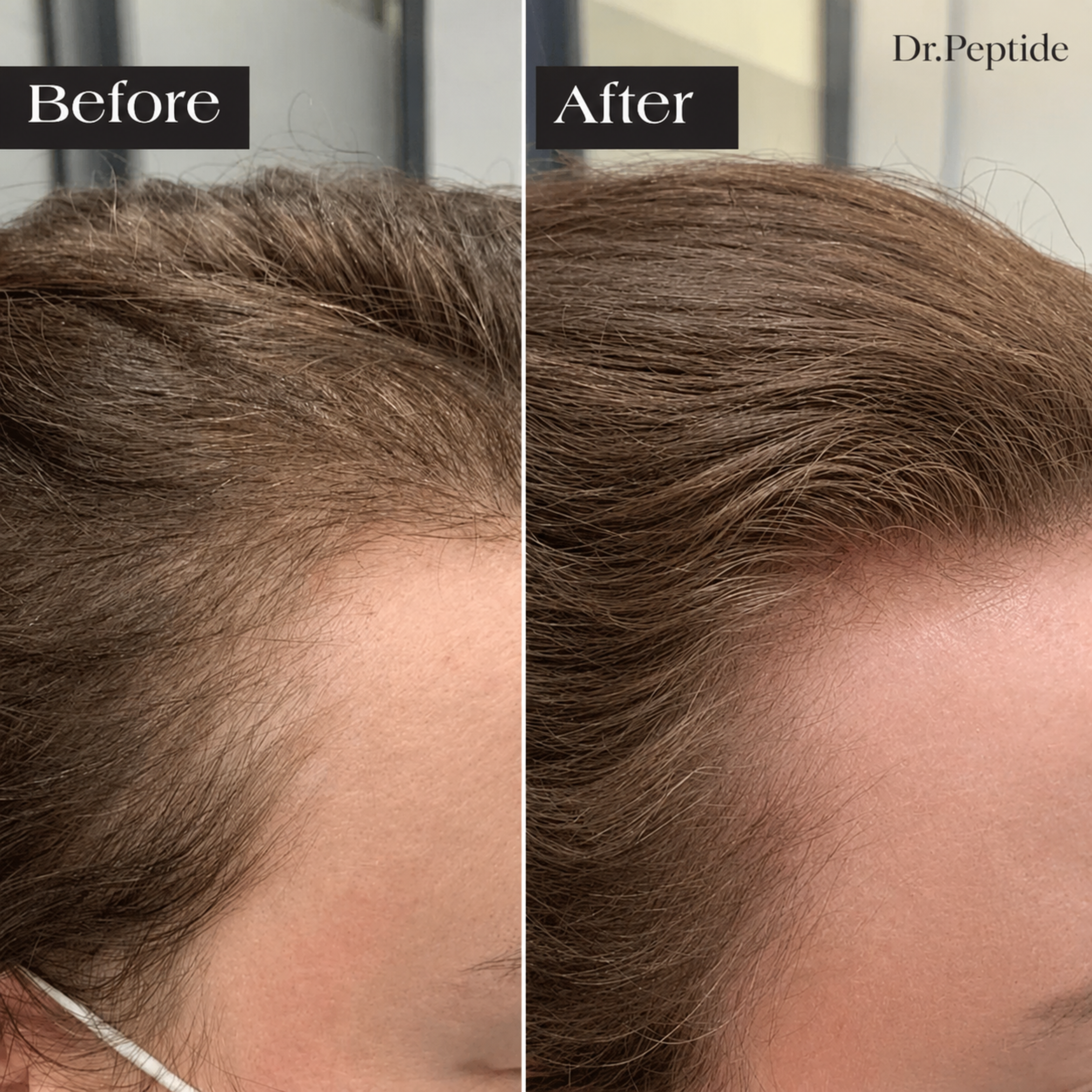 The Most Powerful Peptide Infusion  Hair Regrowth System