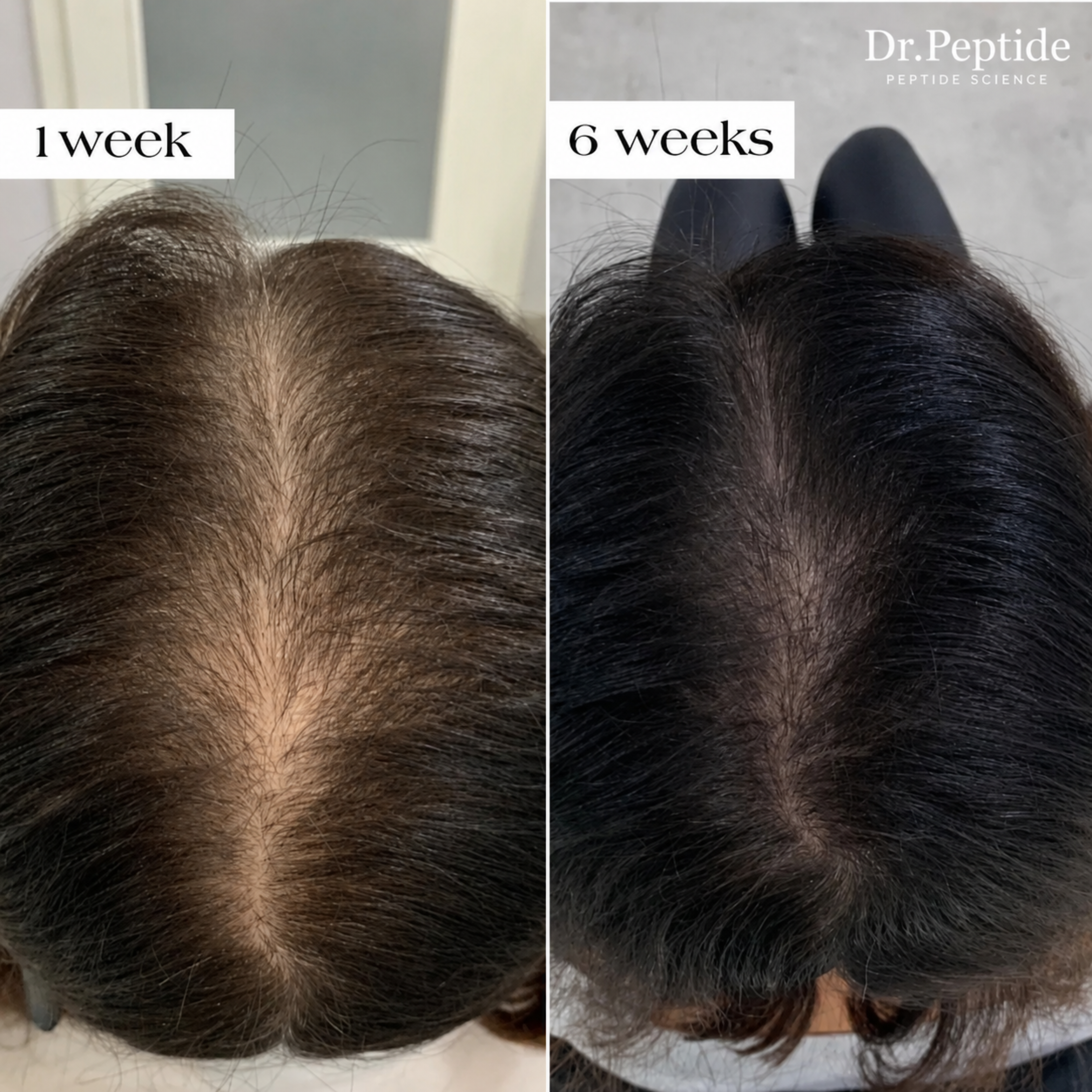 The Most Powerful Peptide Infusion  Hair Regrowth System